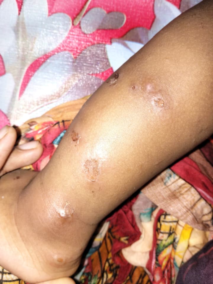 ঢাকায় শিশুদের দেহে ফুসকুড়ি ও ফোসকাযুক্ত রোগের উপসর্গ বৃদ্ধি, উদ্বিগ্ন অভিভাবকরা